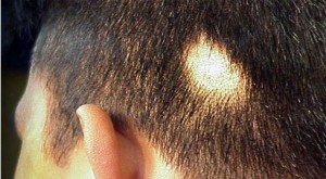 sarımsakla saç dökülmesi tedavisi nasıl yapılır